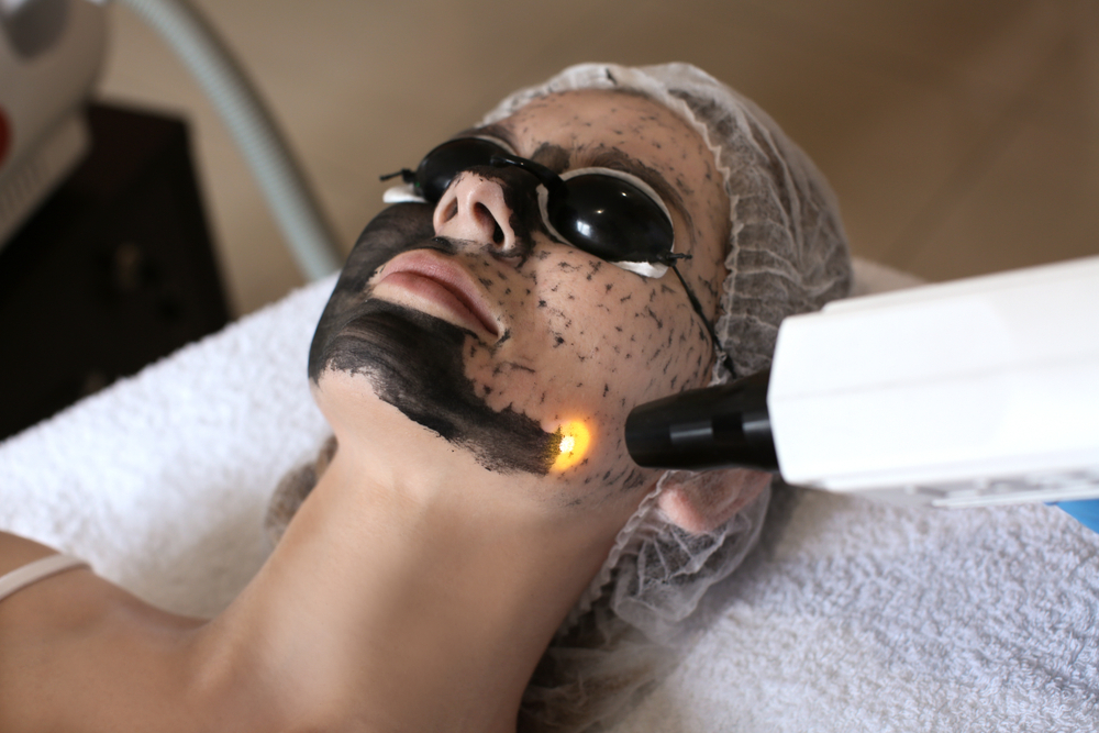 carbol-laser-facial