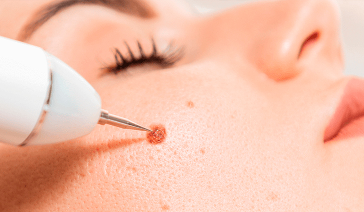 warts-and-moles